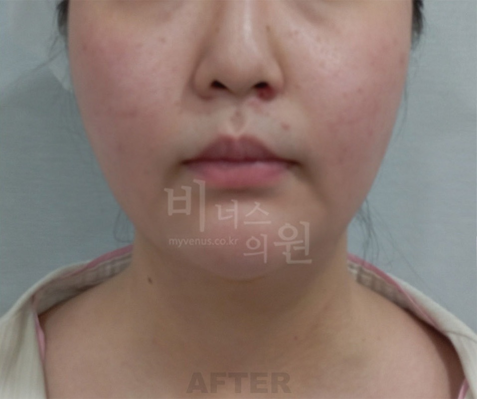 턱·목 지방흡입 첫 번째 환자분 정면 수술 후 1주