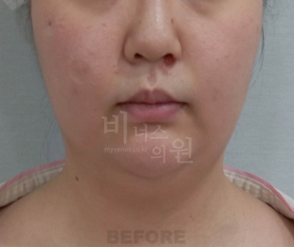 턱·목 지방흡입 첫 번째 환자분 정면 수술 전