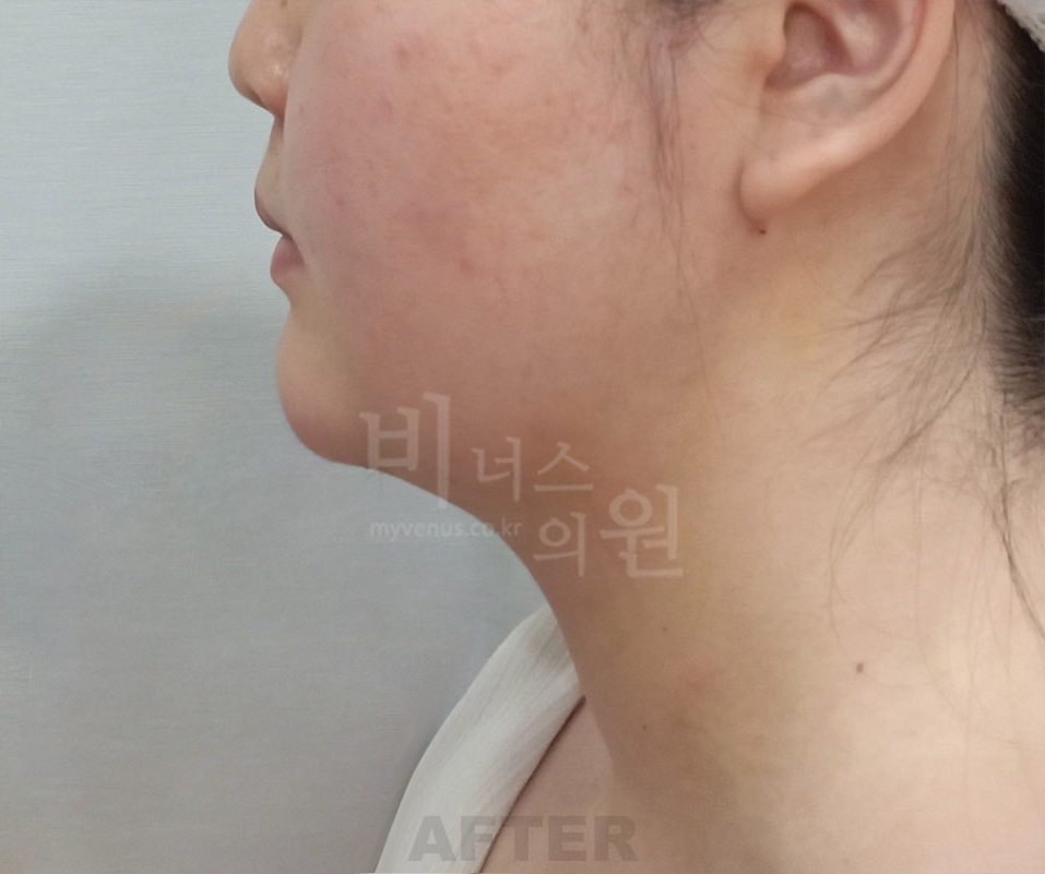 턱·목 지방흡입 첫 번째 환자분 좌측 45도 수술 후 1주