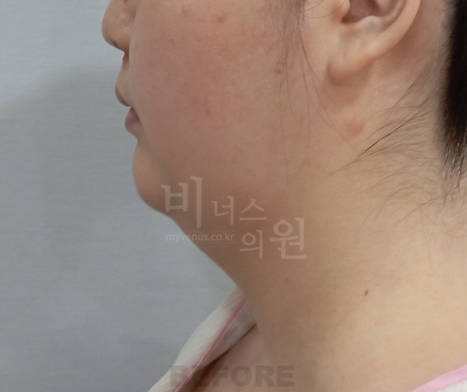 턱·목 지방흡입 첫 번째 환자분 좌측 45도 수술 전
