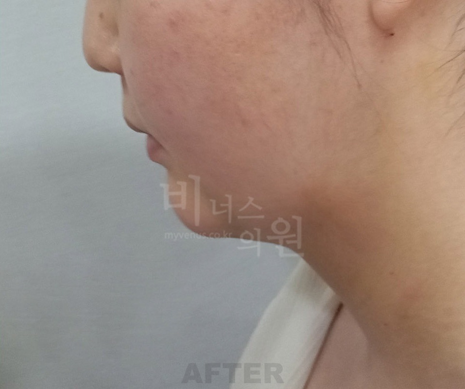 턱·목 지방흡입 첫 번째 환자분 좌측 측면 수술 후 1주