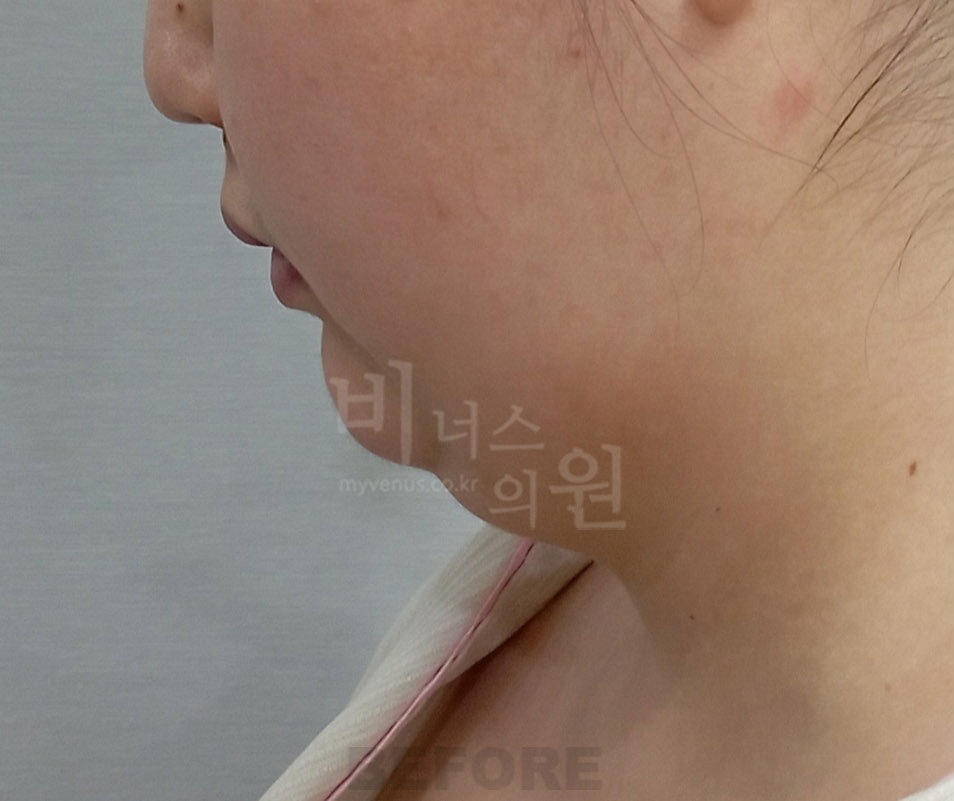 턱·목 지방흡입 첫 번째 환자분 좌측 측면 수술 전