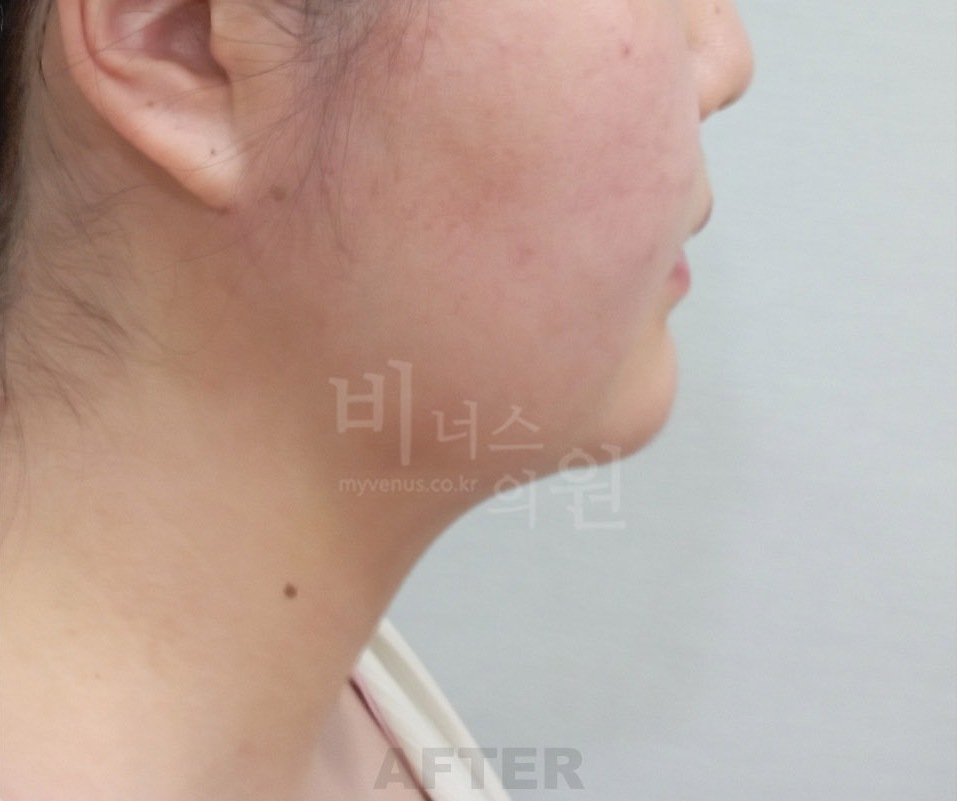 턱·목 지방흡입 첫 번째 환자분 우측 45도 수술 후 1주