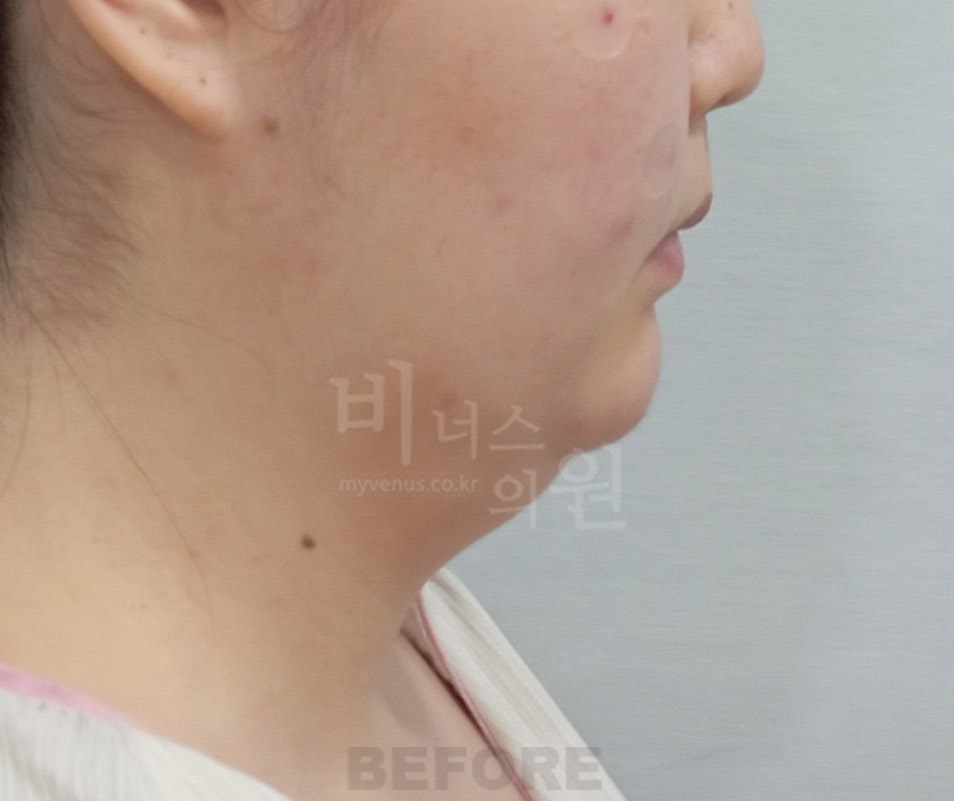 턱·목 지방흡입 첫 번째 환자분 우측 45도 수술 전