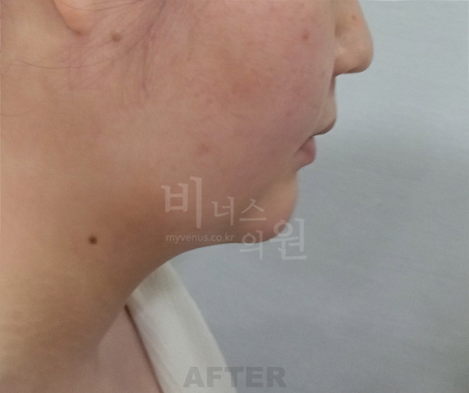 턱·목 지방흡입 첫 번째 환자분 우측 측면 수술 후 1주