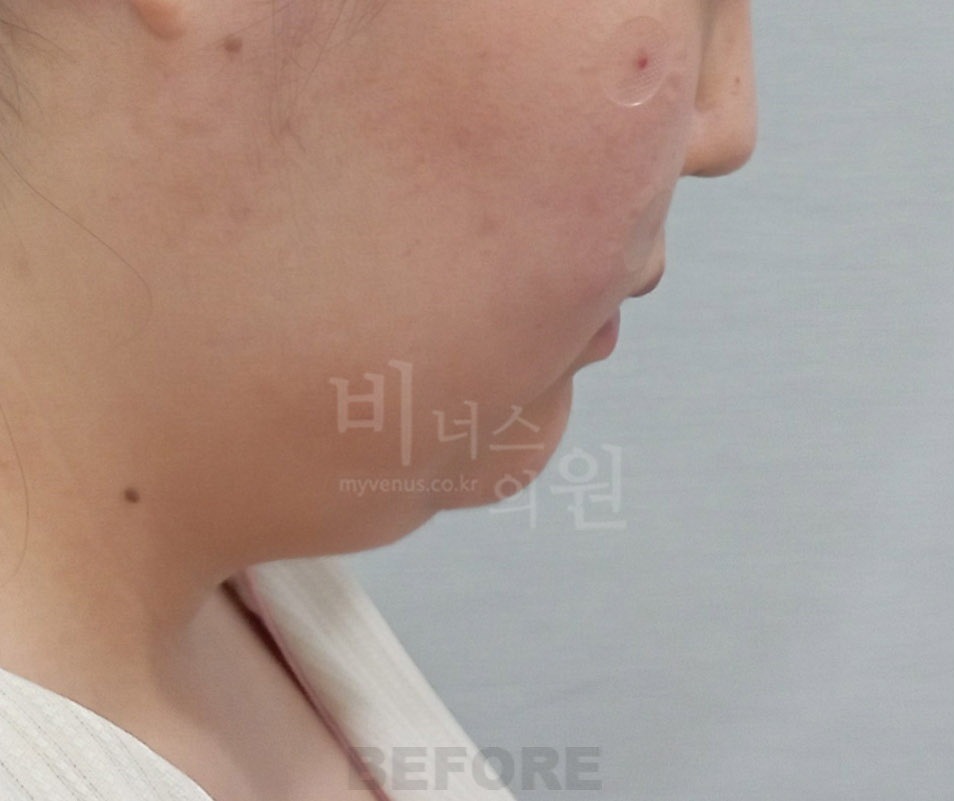 턱·목 지방흡입 첫 번째 환자분 우측 측면 수술 전