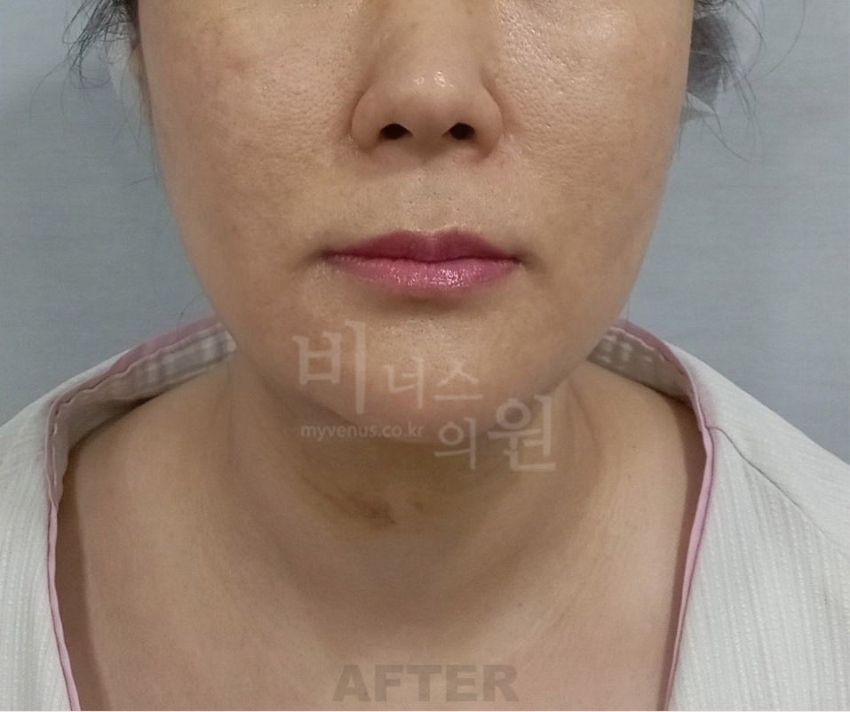 턱·이중턱·목 지방흡입 두 번째 환자분 정면 수술 후 1주