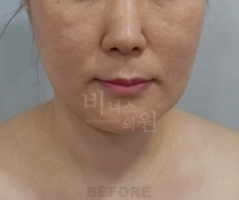 턱·이중턱·목 지방흡입 두 번째 환자분 정면 수술 전
