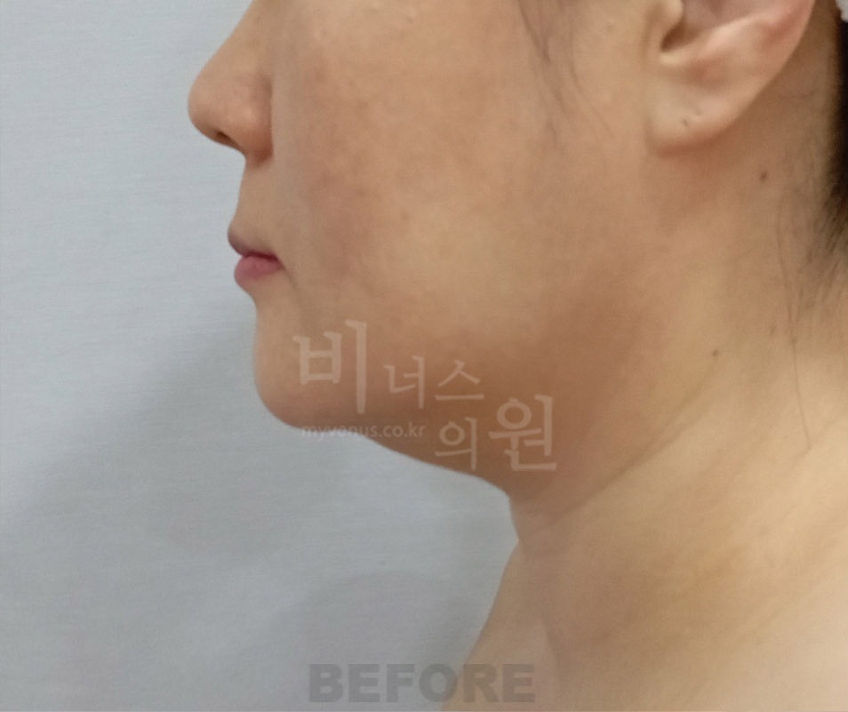 턱·이중턱·목 지방흡입 두 번째 환자분 좌측 45도 수술 전