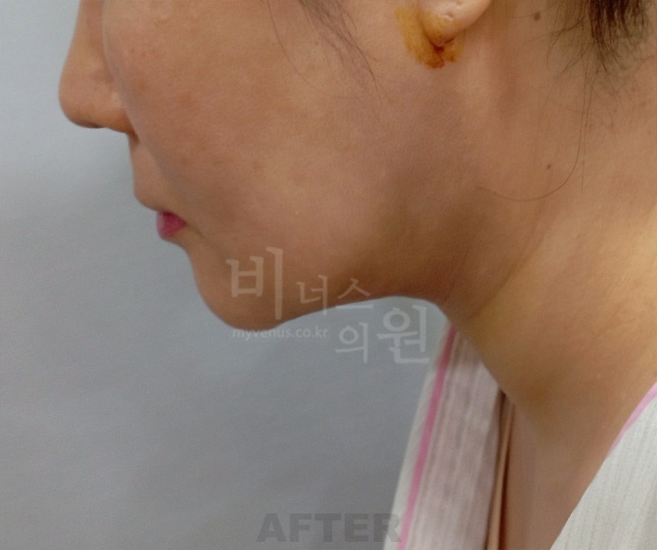 턱·이중턱·목 지방흡입 두 번째 환자분 좌측 측면 수술 후 1주