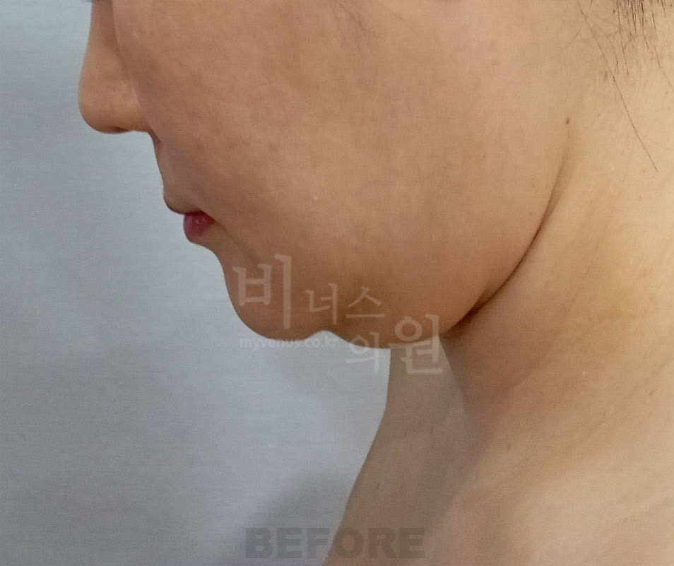 턱·이중턱·목 지방흡입 두 번째 환자분 좌측 측면 수술 전