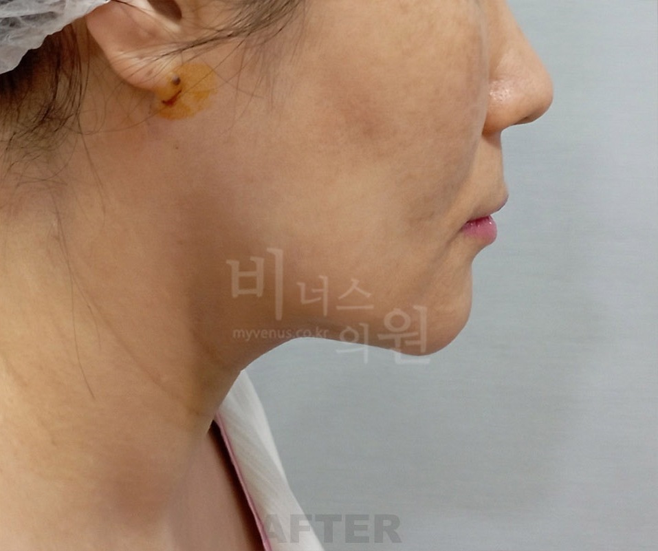 턱·이중턱·목 지방흡입 두 번째 환자분 우측 45도 수술 후 1주