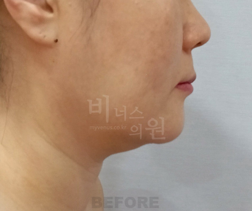 턱·이중턱·목 지방흡입 두 번째 환자분 우측 45도 수술 전