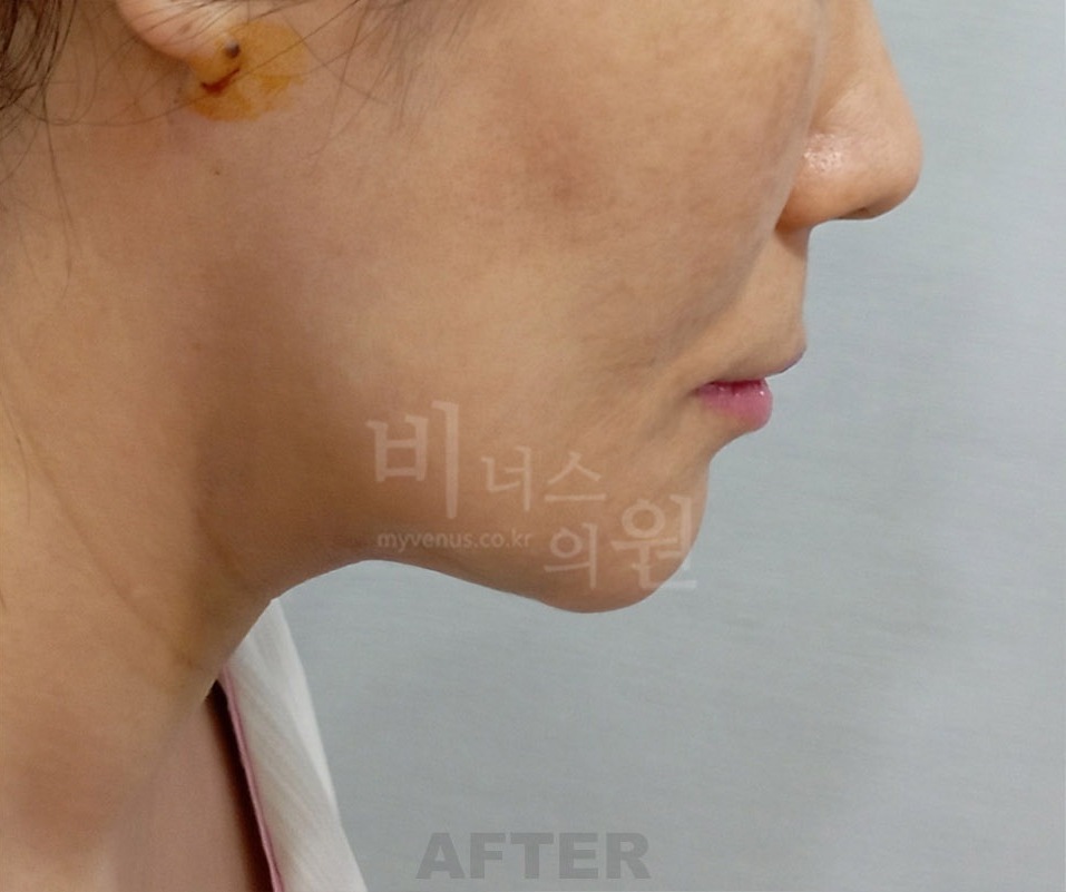 턱·이중턱·목 지방흡입 두 번째 환자분 우측 측면 수술 후 1주