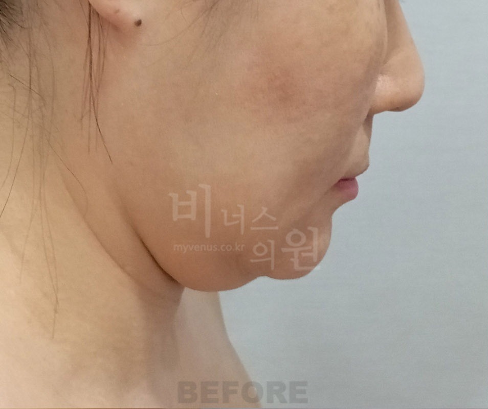 턱·이중턱·목 지방흡입 두 번째 환자분 우측 측면 수술 전
