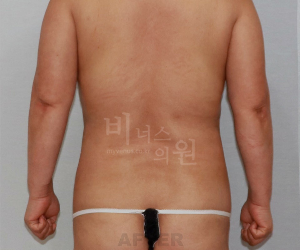 복부지방흡입 수술 후 후면 사진 — 2014년 촬영