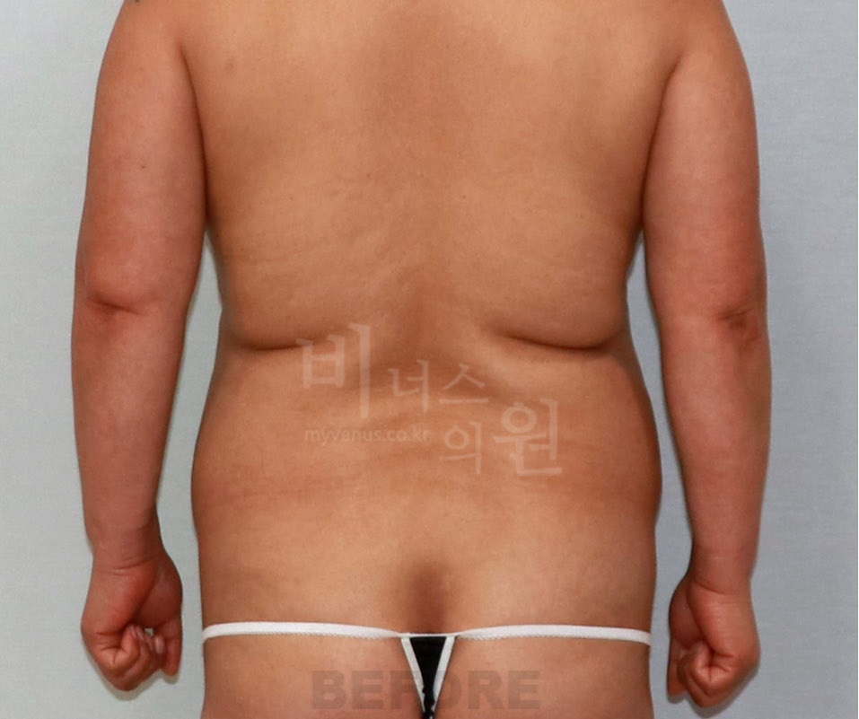 복부지방흡입 수술 전 후면 사진 — 2014년 촬영