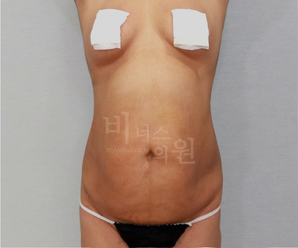 복부지방흡입 수술 후 정면 사진 — 2014년 촬영