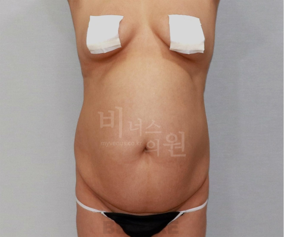 복부지방흡입 수술 전 정면 사진 — 2014년 촬영