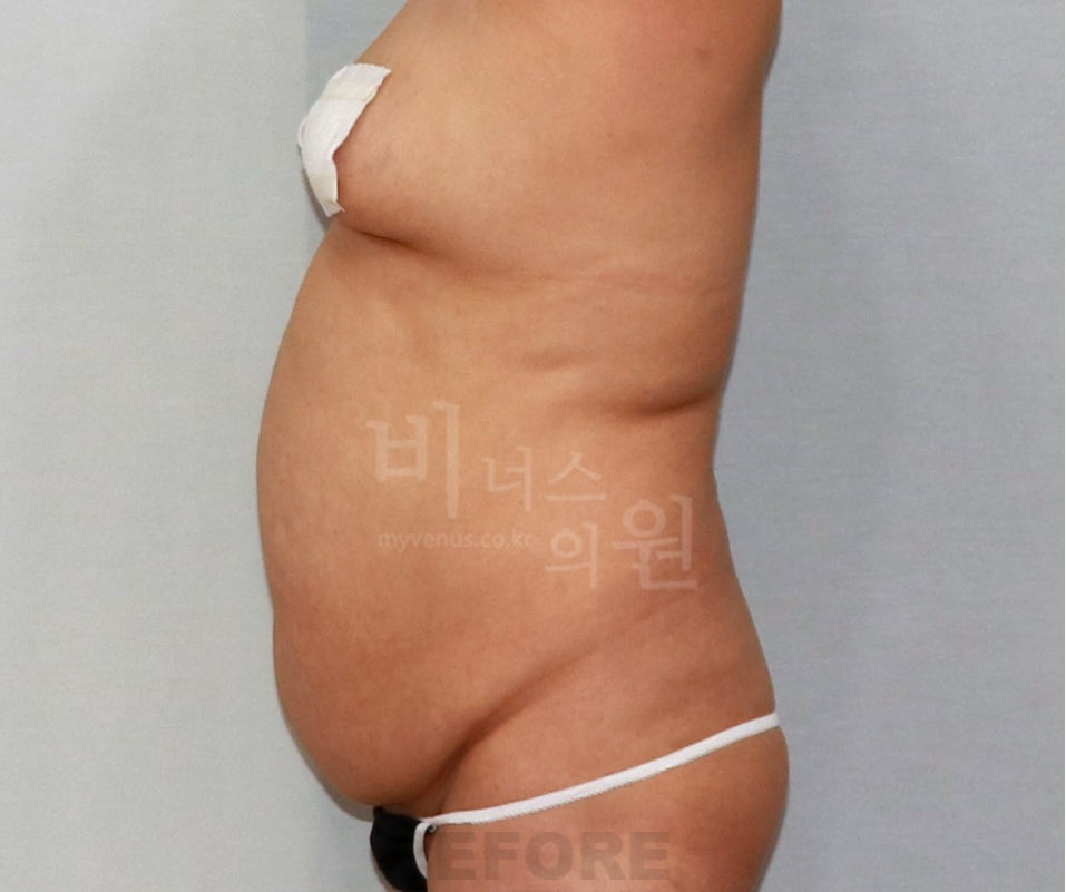 복부지방흡입 수술 전 측면 사진 — 2014년 촬영
